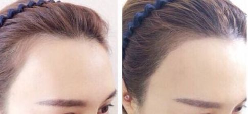 杭州疤痕整形哪家醫(yī)院好？選擇哪個醫(yī)院更靠譜？