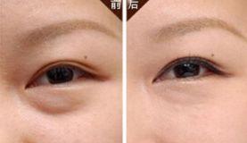 沈陽哪家醫(yī)院做脂肪隆胸效果好且價(jià)格合理？