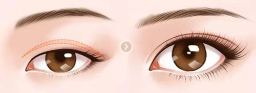 武漢美立方的胡江偉如何進(jìn)行雙眼皮手術(shù)？