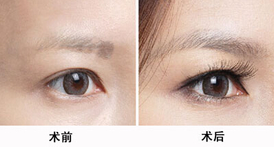 韓國醫(yī)生張柱允的顴骨磨骨技術(shù)整容潮流。