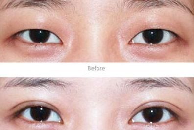 杭州開眼角醫(yī)生哪家好？專家推薦的杭州開眼角醫(yī)院排行榜