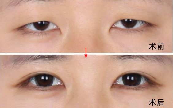 南京哪家醫(yī)院去眼袋好？眼袋手術(shù)選哪家醫(yī)院最好