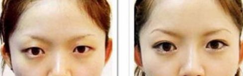 深圳眼袋手術哪家醫(yī)院最靠譜？