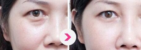 上海知名眼部整形專家出爐！2023年度指定眼王整形專家名單公布，附價(jià)格表參考！