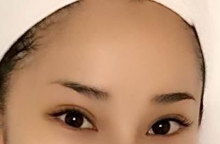 上海醫(yī)院最好治療皮膚疤痕的?？剖悄募遥?>上海醫(yī)院最好治療皮膚疤痕的?？剖悄募遥?/a></h4>
                                    <p>上海是中國的大都市，也是醫(yī)療美容行業(yè)發(fā)展最為成熟的城市之一。在上海，有許多醫(yī)療機(jī)構(gòu)提供專業(yè)的皮膚疤痕治療服務(wù)。下面將介紹幾家在上海治療皮膚疤痕方面表現(xiàn)較好的?？漆t(yī)院。上海華美醫(yī)療美容醫(yī)院上海華美醫(yī)療美容醫(yī)院是一家全國性連鎖醫(yī)療美容機(jī)構(gòu)，擁有規(guī)模較大的整形外科醫(yī)生隊(duì)伍。每位醫(yī)生都有自己的擅長項(xiàng)目，并取                                    </p>
                            </div>
                        </div>
                    </li>
	
                </ul>
            </div>
        </div>
        <div   id=