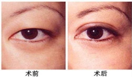 杭州做激光眼科手術(shù)哪家醫(yī)院好，專家推薦