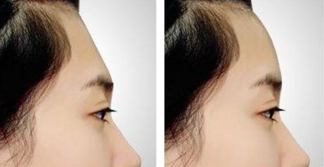 南京割雙眼皮哪家醫(yī)院效果好？