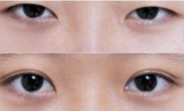 秦皇島雙眼皮哪家做的好？選擇前必看！
