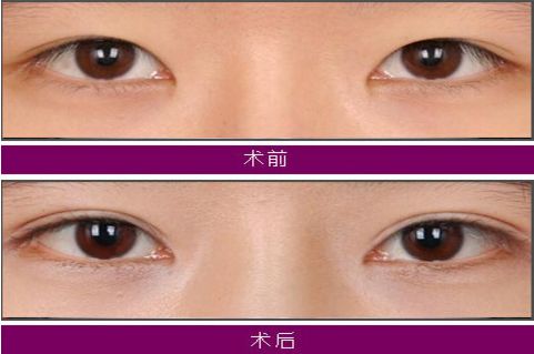大連注射玻尿酸哪家醫(yī)院技術(shù)好，效果持久？