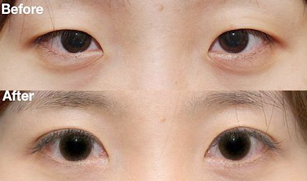 2023深圳黃金微針去除口周紋醫(yī)生綜合實力排行榜(鄭瑜璠、吳曉玲、劉彤大勢醫(yī)美重磅來襲)