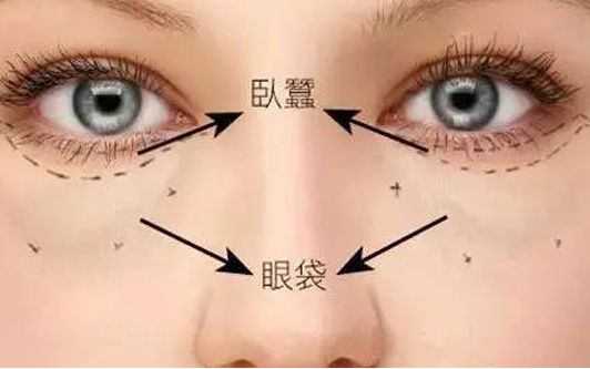 海口哪家醫(yī)院做眼袋效果好？