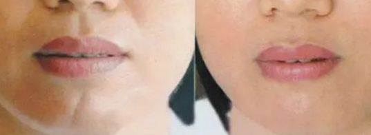 上海面部除疤效果最好的醫(yī)院有哪些？