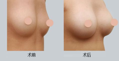 西安墊鼻梁技術(shù)好的醫(yī)院有哪些？