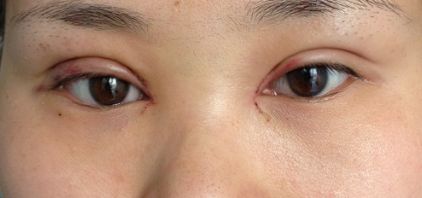 沈陽哪家醫(yī)院疤痕手術(shù)效果好？