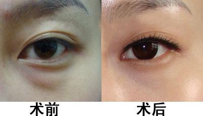 上海天壇普華醫(yī)院優(yōu)秀拉皮專家解析，手術(shù)費(fèi)用清單附中