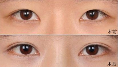 大連假體隆鼻哪家醫(yī)院好？打造完美鼻型，這家醫(yī)院是最佳選擇！