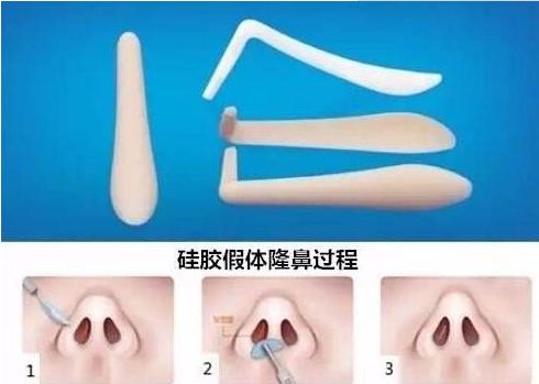 北京哪家醫(yī)院祛除眼袋效果最好？
