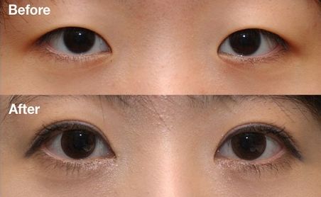 杭州雙眼皮醫(yī)院排名Top1，哪家醫(yī)院做雙眼皮效果好？