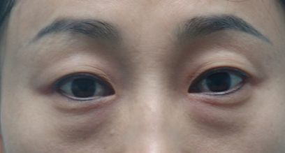 天津醫(yī)院去疤膏效果好的有哪些？