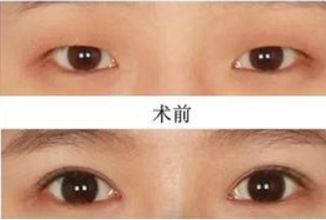 昆明哪家醫(yī)院做熱瑪吉好？挑選昆明熱瑪吉治療專業(yè)的醫(yī)院指南