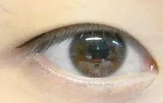 揭曉2023年武漢哪家醫(yī)院割雙眼皮好，專家推薦及真實案例！
