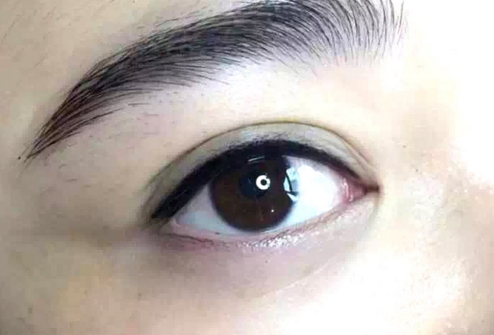 廣州金孝憲鼻部整形效果圖示，值得一看的真實案例！