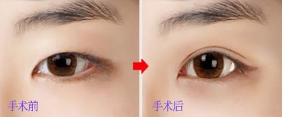 上海玻尿酸豐唇哪家醫(yī)院好？挑選上?？诒玫牟Ｄ蛩嶝S唇醫(yī)院