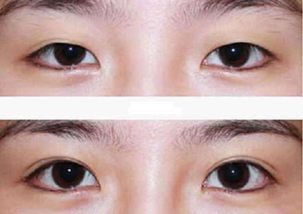 【2023年蘭州歪脖子手術(shù)哪家好？專家推薦+真實(shí)案例分析】
