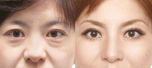 成都做乳暈漂紅哪家好？乳暈漂紅的價格、效果、方法哪種最合適？