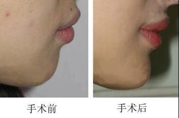 昆明哪家醫(yī)院做上臉下垂手術好，醫(yī)生技術靠譜？