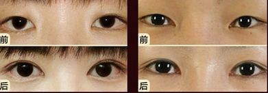 嘟嘟唇無(wú)錫哪家醫(yī)院好？專家推薦無(wú)錫哪家醫(yī)院治療嘟嘟唇好