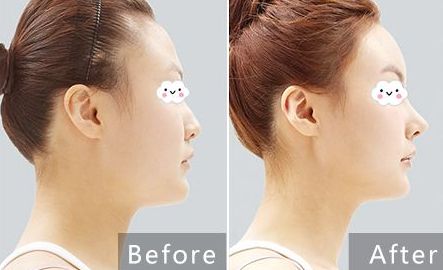 貴陽治療痘坑哪家醫(yī)院專業(yè)可靠？