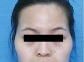 成都治療臉上痘痘哪家醫(yī)院好？專(zhuān)家推薦的成都治痘好醫(yī)院大揭秘！