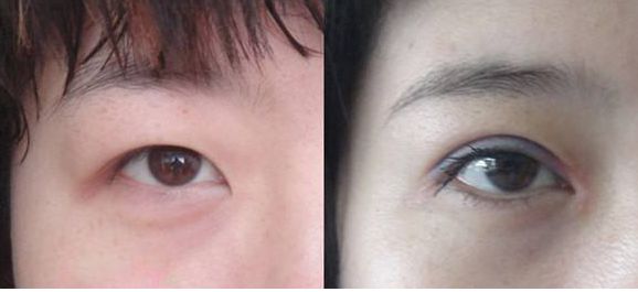 上海市激光修復(fù)痘坑效果如何？哪家醫(yī)院技術(shù)更好？