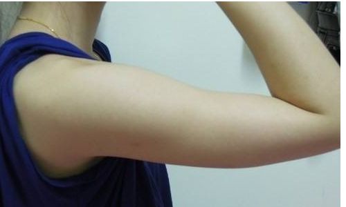 杭州連天美脂肪填充效果如何？醫(yī)院實力是否值得信賴？