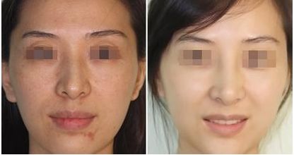 沈陽眼袋整形哪家醫(yī)院好？