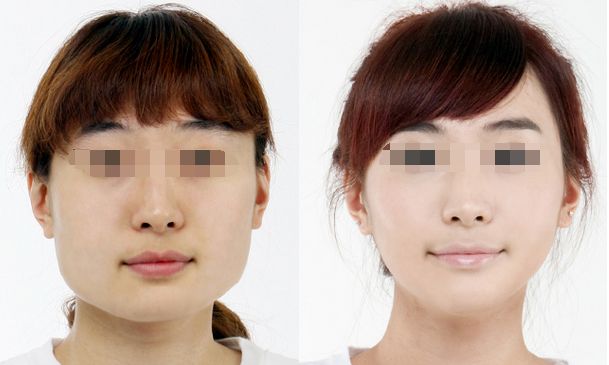 合肥哪家醫(yī)院豐胸效果好，專業(yè)的豐胸醫(yī)院推薦