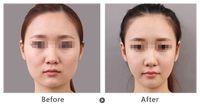 矯正牙齒需預(yù)估費(fèi)用？費(fèi)用注意事項(xiàng)解析！