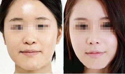 激光去除眼袋，持久效果有多久？價格如何，眼周抗衰秘笈大揭示