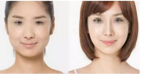 威寧隆胸手術(shù)效果如何？術(shù)后持久無需擔(dān)心！