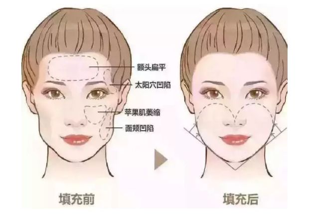 果酸療程：花多少錢一次？肌膚煥變?nèi)ヂ裕?xì)節(jié)也不能忽視！