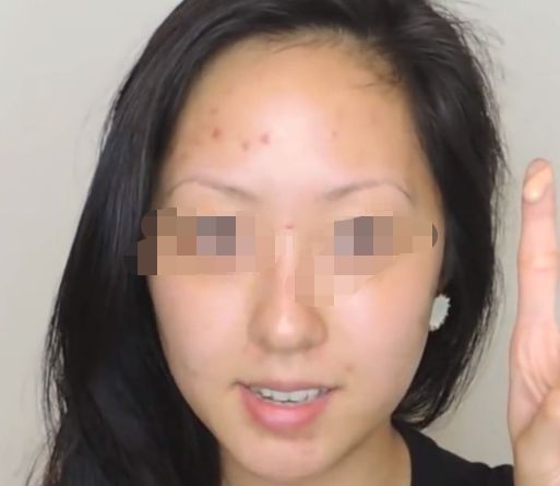 延長透明質(zhì)酸隆鼻效果，多種小竅門讓您保持完美鼻形