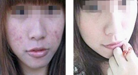 危害程度如何？全方位解析臉部拉皮手術(shù)風(fēng)險與安全
