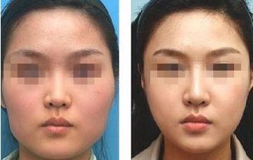 如何改善圓臉型，輕松塑造瓜子臉？五個有效技巧揭秘！