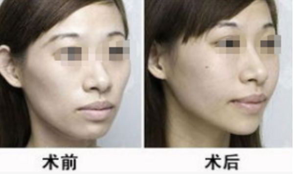 地包天整形手術：對面部神經有何影響？