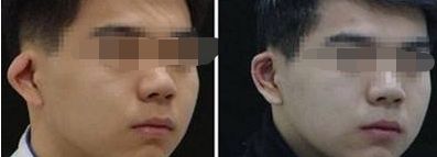 有效解決雙眼皮修復(fù)，手術(shù)方法和時(shí)間探究