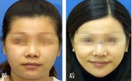 透明質(zhì)酸隆鼻價格多少？價位調(diào)查報告來襲！