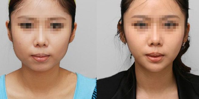 低凹鼻梁怎樣通過隆鼻手術(shù)改善？