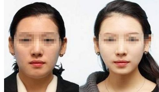 彩光嫩膚：一個(gè)療程要多少次才有效？