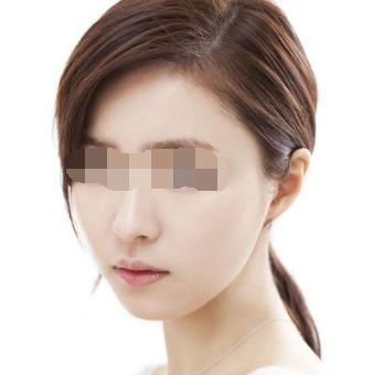 假體鼻隆術(shù)：不同材料對比及其優(yōu)勢